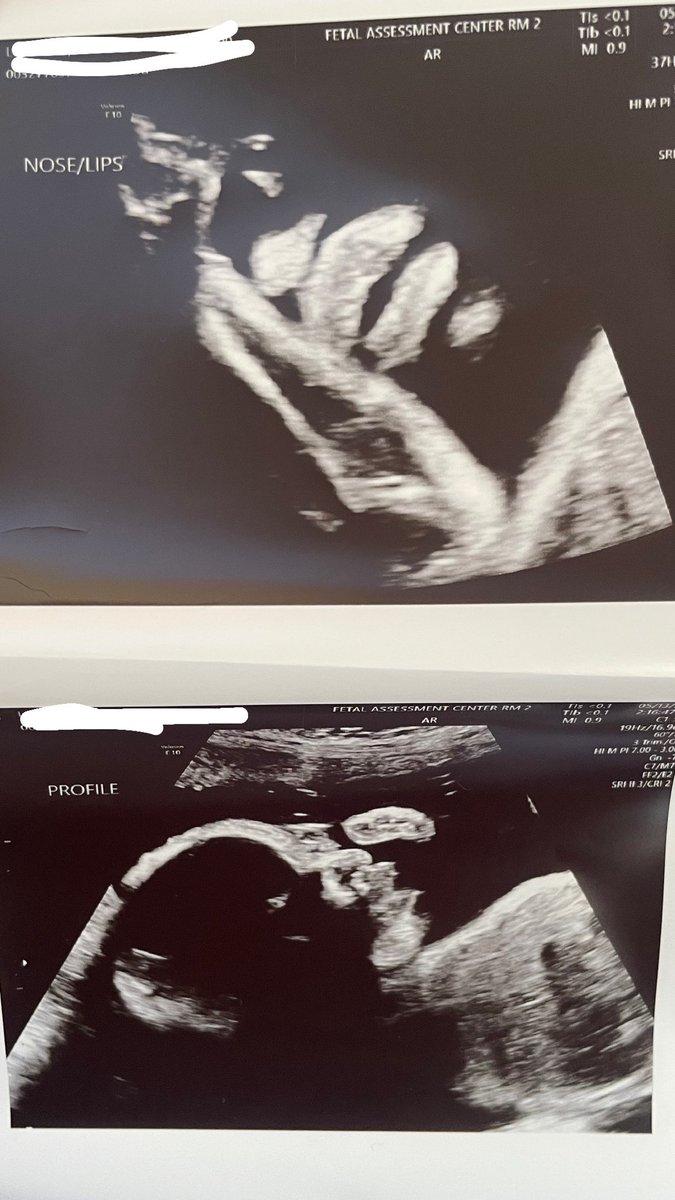 XoxoAlyciaa's tweet image. A.E.G💜🦋
She’s still underweight we have to go twice a week now😩she gots her daddy’s big lips &amp;amp; always keeps her hands up it was hell tryna get the first picture of her face😩😂💗 #7weeksleft