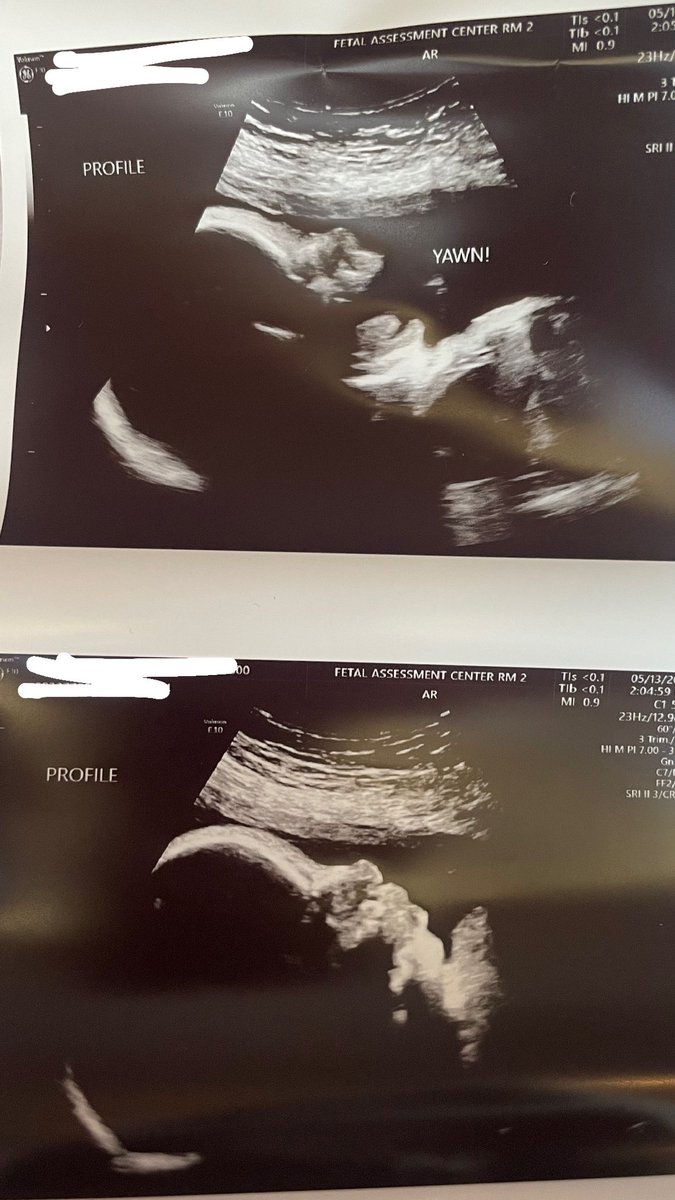 XoxoAlyciaa's tweet image. A.E.G💜🦋
She’s still underweight we have to go twice a week now😩she gots her daddy’s big lips &amp;amp; always keeps her hands up it was hell tryna get the first picture of her face😩😂💗 #7weeksleft