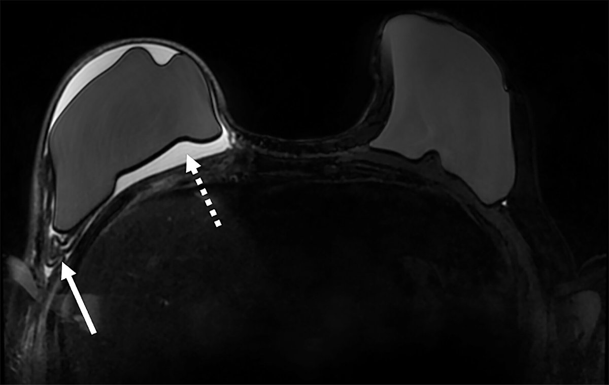 Check out this overview of multimodality imaging of the postmastectomy reconstructed breast, which includes an update on screening guidelines and recommendations for this patient population. <a href="/fsodagari/">Faezeh Sodagari, MD</a> <a href="/ButlerReni/">Reni Butler</a> bit.ly/3wsGbuC