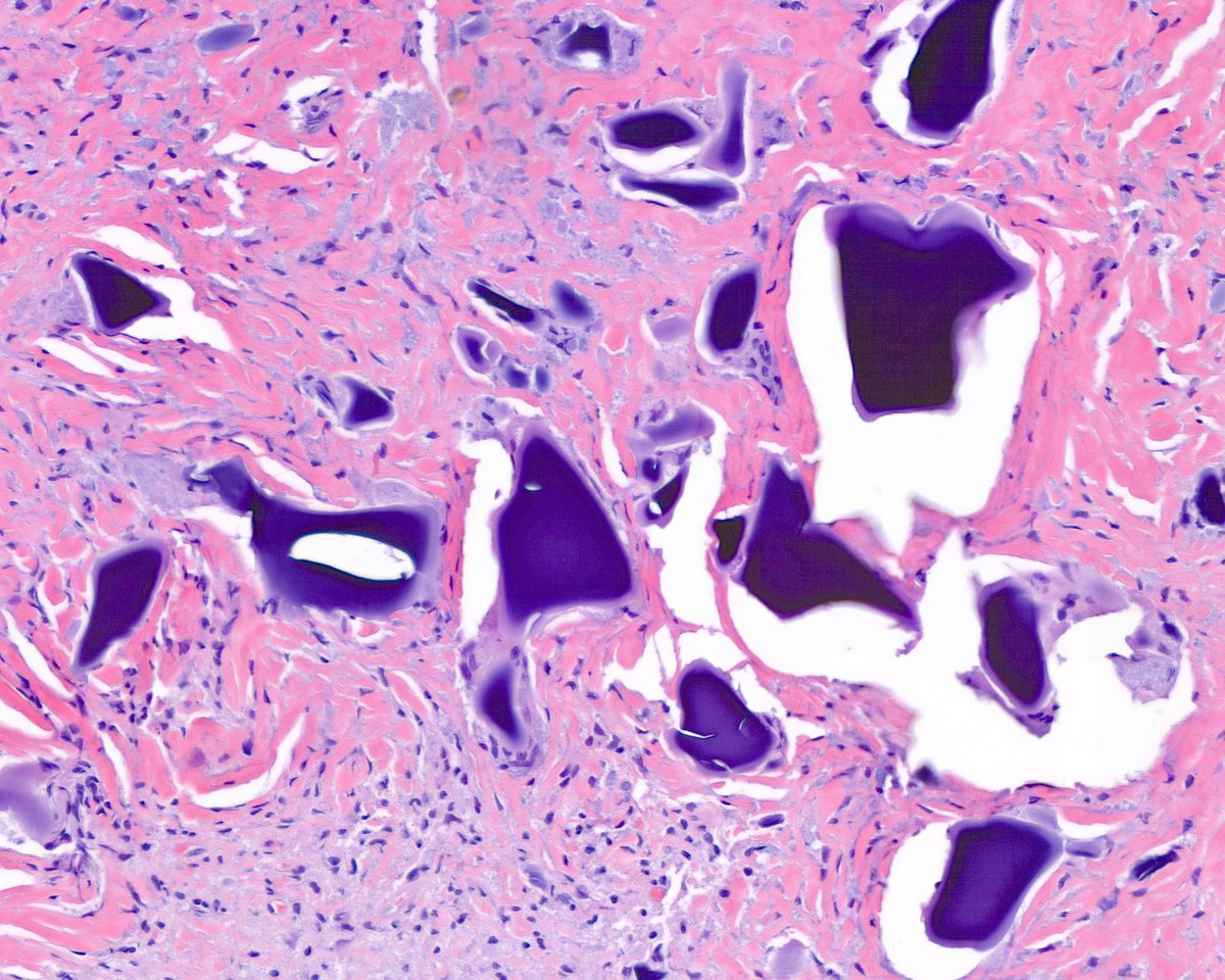 Wound-Seal: it’s baaaaaack!