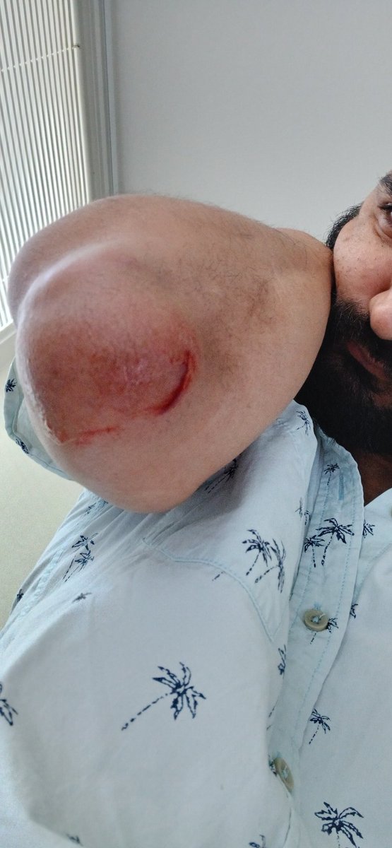 grumpbert's tweet image. Mi primera sacada de chucha de retorno al país natal