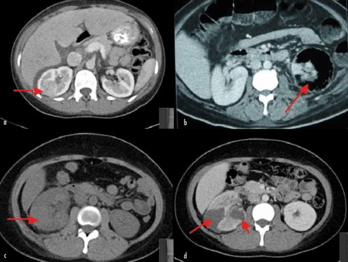 Have you ever heard of acute lobar nephronia?

a. Acute lobar nephronia
b. Emphysematous pyelonephritis of the L kidney
c. Non-contrast CT w/ acutely swollen R kidney with perinephric stranding consistent w/ acute pyelonephritis
d. Same 😷 1 week later w/ renal abscess formation