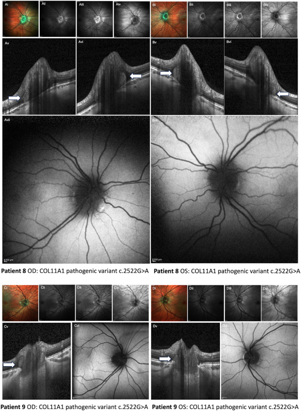 Ophthopedia Update: Peripapillary Hyper-Reflective Ovoid Mass-like Structures in Stickler syndrome. dlvr.it/T6qW3t #Ophthalmology #Retina #Ophthotwitter