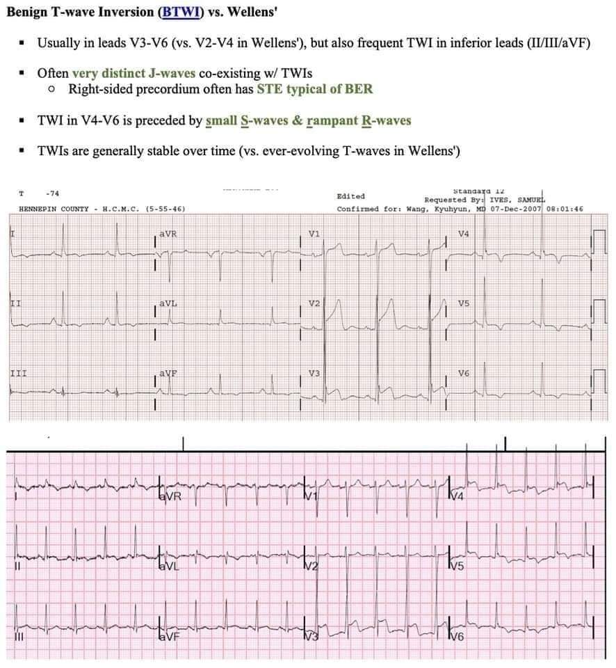 🔴Two early repolarization variants (funky ST-T segments):
    1. Benign early repolarization
    2.Benign T-wave inversion