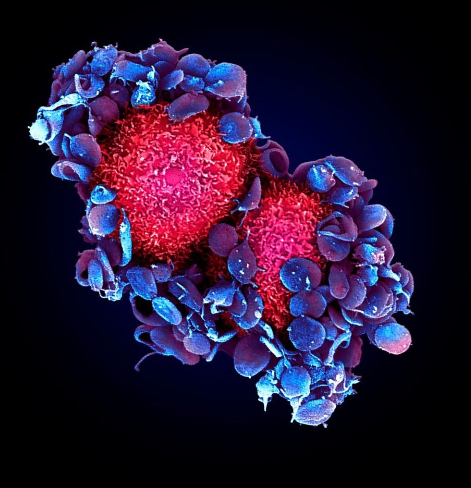 Jacky GOETZ (@goetzjacky) on Twitter photo 💥Check out our latest work just out <a href="/NatureComms/">Nature Communications</a>
🔬#Platelets shape the outgrowth of #metastasis, even growing & established foci.
🎯We further identified #targets and tools with therapeutic potential
rdcu.be/dHL7i
#mouse #zebrafish #imaging #Immunology #hemostasis 💥Check out our latest work just out <a href="/NatureComms/">Nature Communications</a>
🔬#Platelets shape the outgrowth of #metastasis, even growing & established foci.
🎯We further identified #targets and tools with therapeutic potential
rdcu.be/dHL7i
#mouse #zebrafish #imaging #Immunology #hemostasis