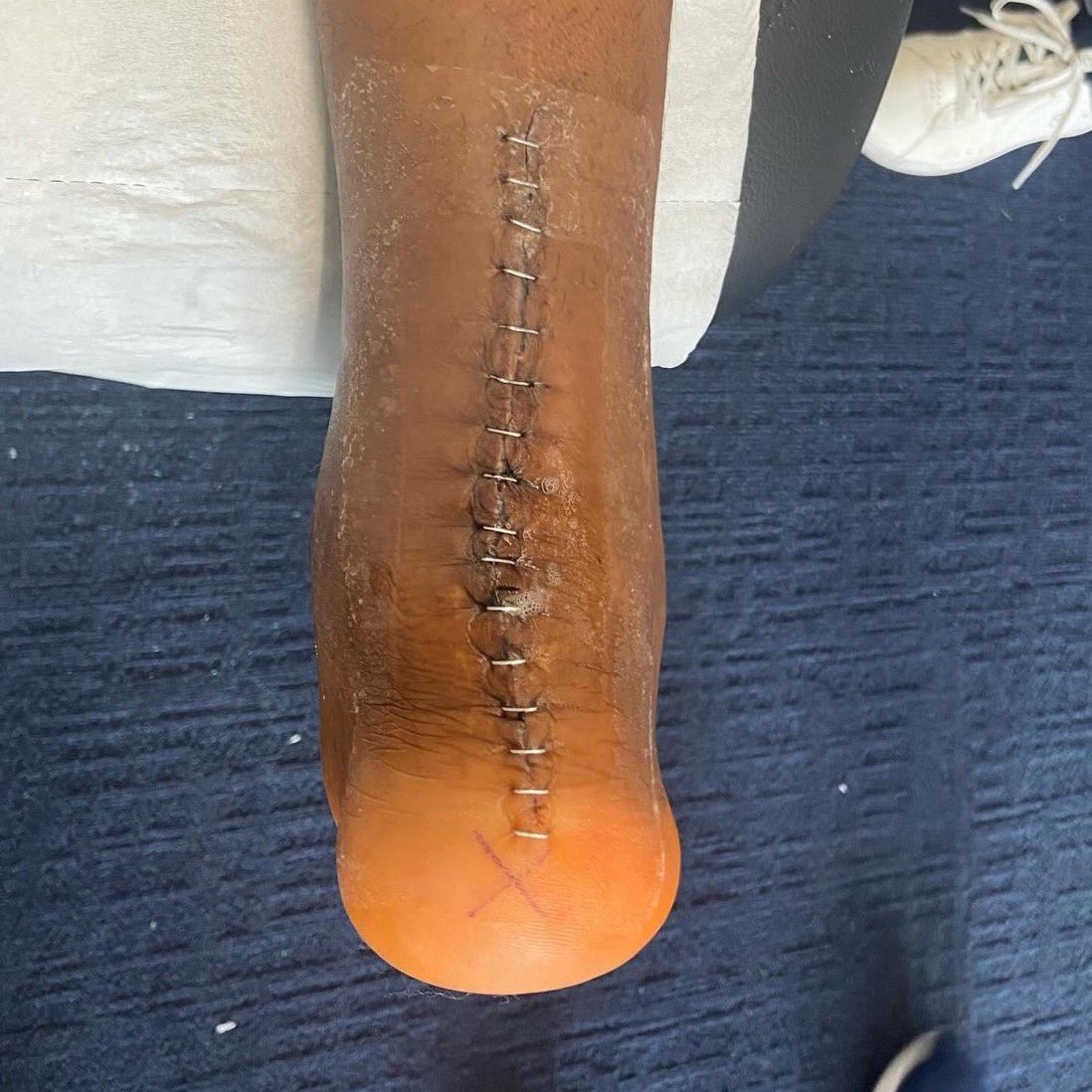 🩼😣 Presnel Kimpembe reveals the extent of his latest injury: an Achilles tendon rupture that has sidelined him for over 400 days. The image captures the back of his foot, stitched up. Wishing him strength during his recovery. 🙏