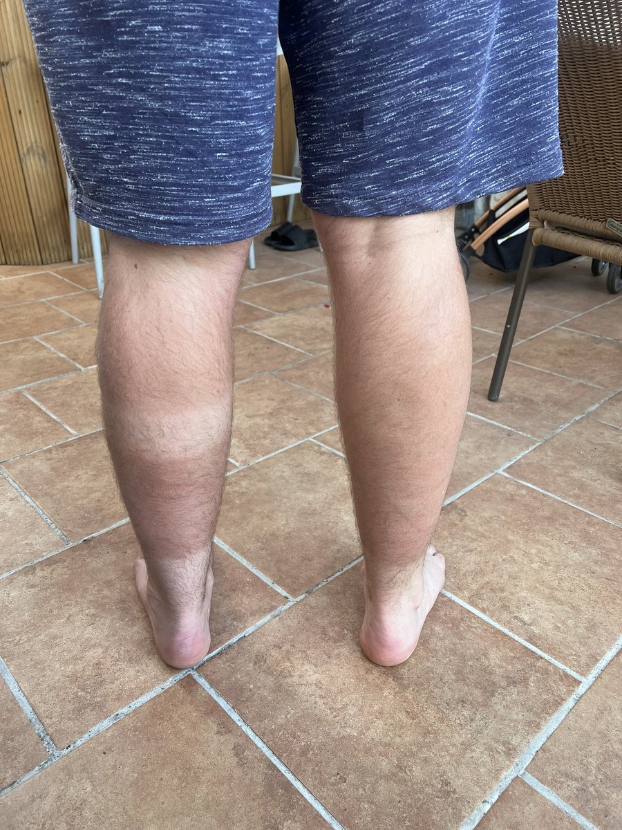 GorillaManFitn1's tweet photo. Check out my Tan lines from wearing my leg splint today….. The joys of wearing a leg splint 💪🦵 #tanlines #tanlinesandgoodtimes #mijas #allardsplints #legsplint https://t.co/5xkZ2oAq1r