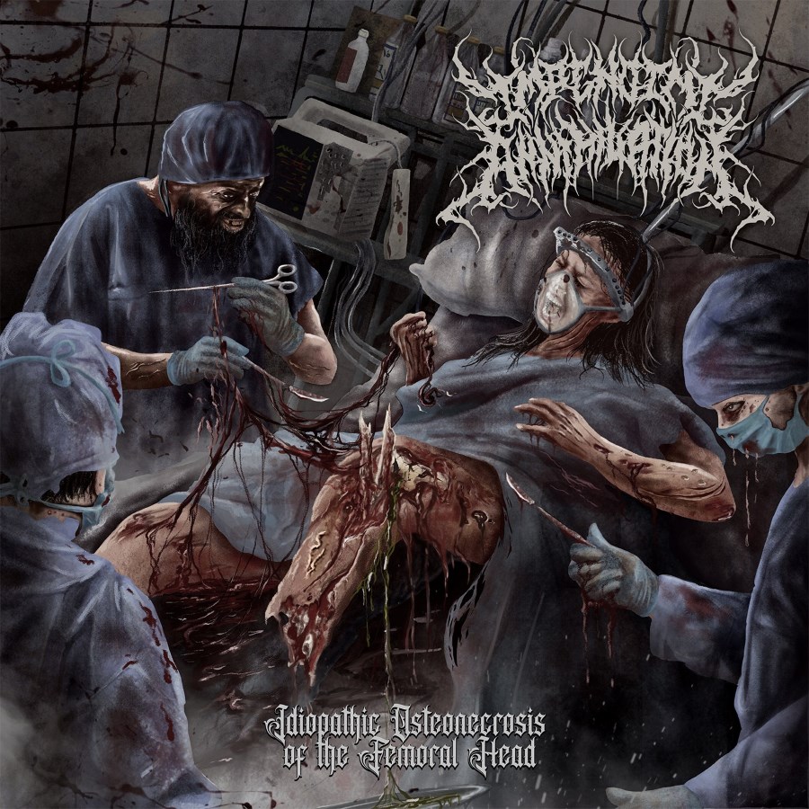 Impending Annihilation — Idiopathic Osteonecrosis Of The Femoral Head (2024) #TechnicalBrutalDeathMetal open.spotify.com/album/486gHS7r…