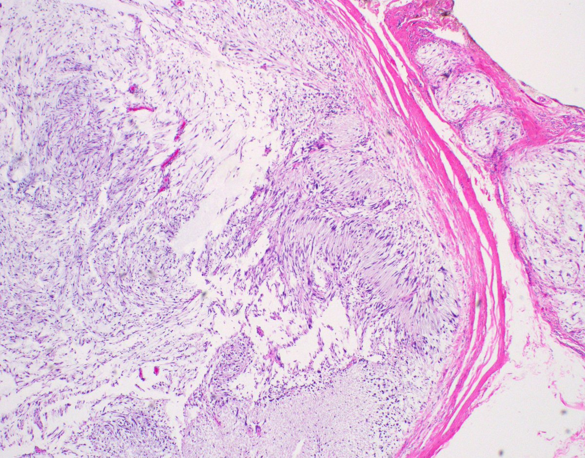 Finger nodule in adult. Your diagnosis? 
More pics kikoxp.com/posts/16056 
Answer  ✅ youtube.com/watch?v=FaWOul… 
AMAZING Gross pic: kikoxp.com/posts/20986 
#pathology #pathologists #pathTwitter #dermpath #dermatology #BSTpath #dermtwitter