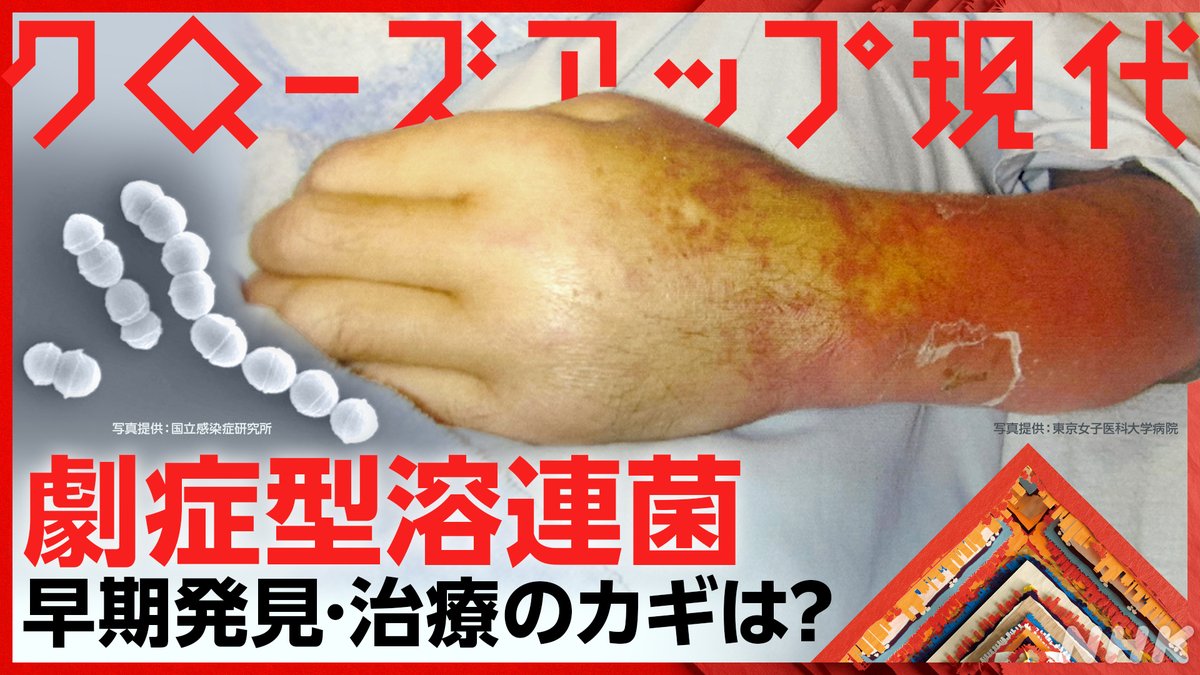 手足の壊死や多臓器不全で死に至る恐れのある #劇症型溶連菌 。 致死率3割。感染者数は過去最多のペースで増え続けており、初期症状のサインは医師でも見分けづらいとされています。 感染対策は？ 早期発見・治療のカギは？ 今夜7時半・NHK総合 #クロ現 でお伝えします。