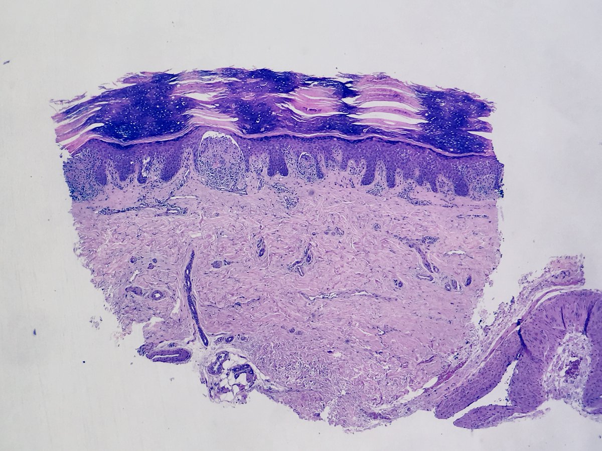 igor_dermpath's tweet photo. Two images. 52 y/o woman. This rash began 5 months ago. No symptoms, only affecting palmar and plantar regions (ppr). What is your diagnosis? Have you ever seen one case like this on ppr? #dermatology #dermatopathology #dermpath #argospatologia https://t.co/PFdl6Me24s
