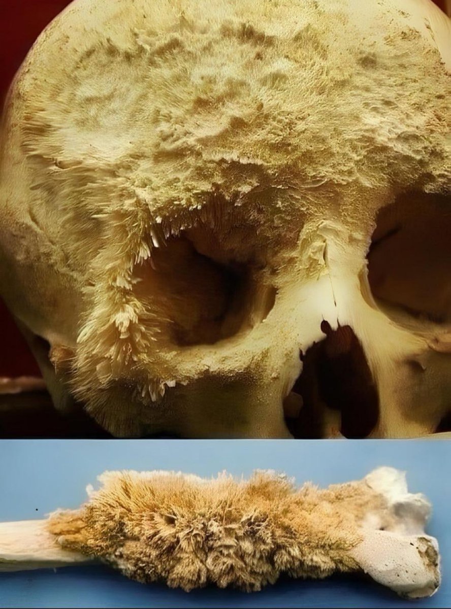 ステージ 1 の骨癌のある 人間の頭蓋骨💀😱🤔