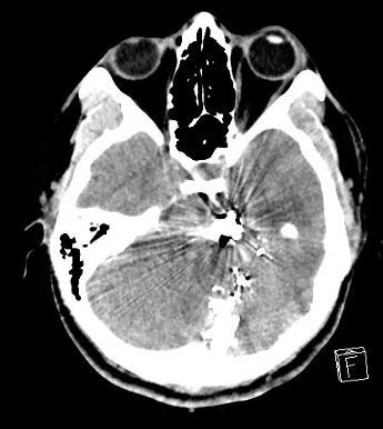 CNS_Update's tweet photo. #CNSNexus case featuring Ryan Kitigawa &amp; Laura Zima from UT Health! Patient presenting after posterior GSW. What vascular structure is likely injured? (1/5) https://t.co/OH63weF2cd