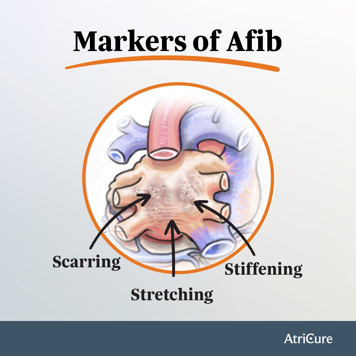 Early signs of Afib can be detected before the first episode. Heart damage, like left atrium changes, can lead to scarring, a key factor in Afib. Learn more at okt.to/2gy8Hp References: okt.to/CmLntA okt.to/2dEDCA okt.to/pB2Elx