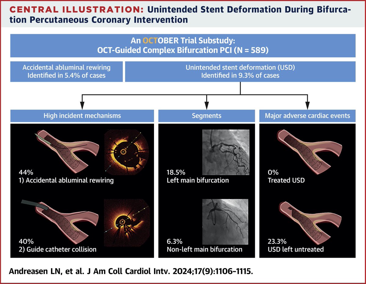 Niels R. Holm (@nielsrholm) on Twitter photo New <a href="/OctoberTrial/">OCTOBER Trial</a> analysis in JACC Intv led by <a href="/LNAndreasen/">Lene Nyhus Andreasen</a> ;
Unintended stent deformation (USD) was associated with very poor outcome - But if USD was identified by OCT and corrected the prognosis was fine.
USD was identified in 18% of LMCA PCI cases (!)
Causes were equally New <a href="/OctoberTrial/">OCTOBER Trial</a> analysis in JACC Intv led by <a href="/LNAndreasen/">Lene Nyhus Andreasen</a> ;
Unintended stent deformation (USD) was associated with very poor outcome - But if USD was identified by OCT and corrected the prognosis was fine.
USD was identified in 18% of LMCA PCI cases (!)
Causes were equally