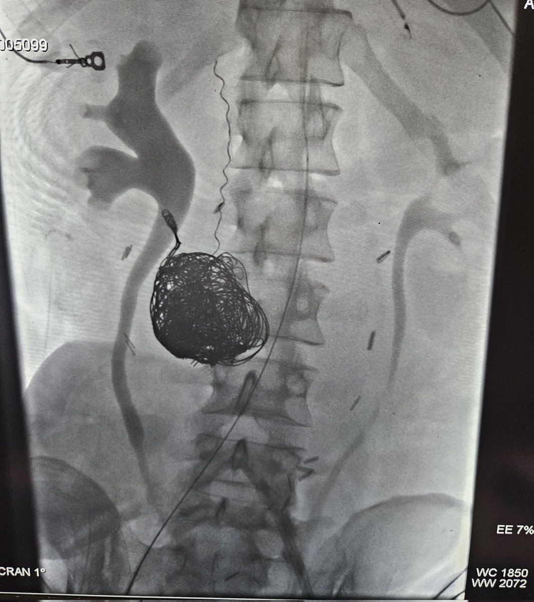Great case coiling a large SMA pseudoaneurysm.