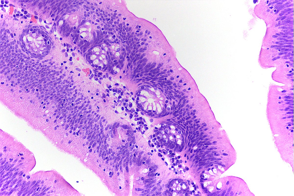 Very nice ectopic crypts in a Traditional serrated adenoma.

#gipath #Pathology