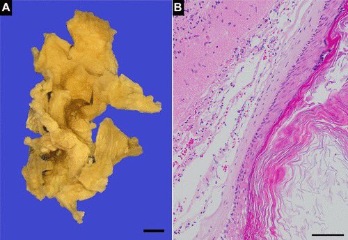 14yo w/ unsteady gait x 2 wks CT: Heterogeneous posterior fossa mass, near-water attenuation w/ coarse Ca++, causing hydrocephalus MR: Mixed signal intensity on all sequences & minimal peripheral enhancement Dx: Dermoid cyst w/ @francisdeng Full text:doi.org/10.1148/radiol…