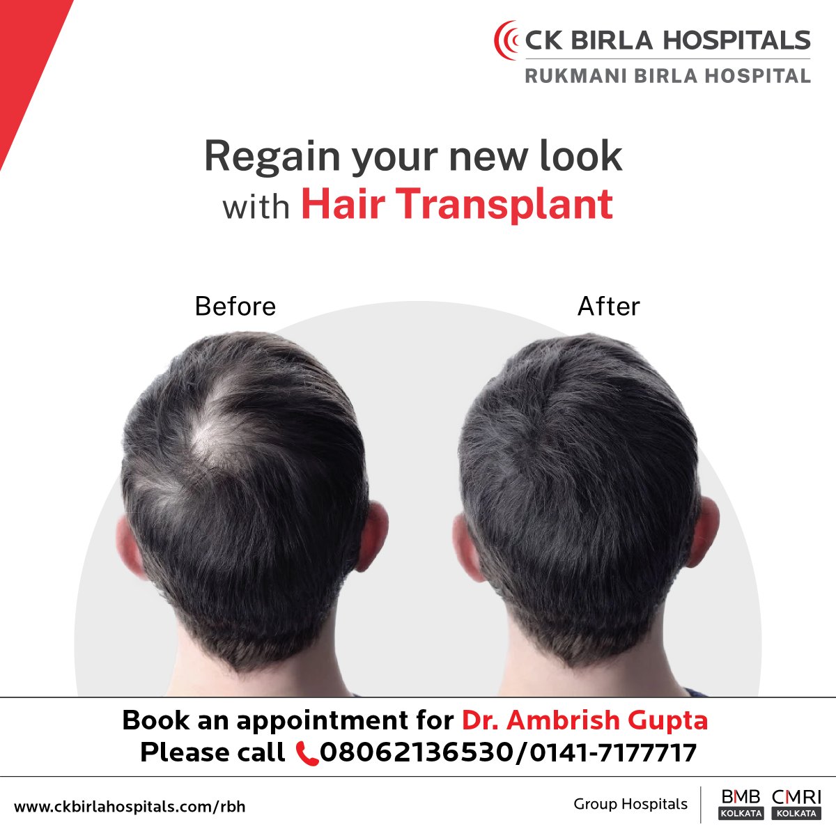 Say Goodbye to Hair Loss, Hello to Confidence!  Are you tired of dealing with hair loss?  Our expert surgeons use the latest techniques to ensure  natural-looking results. #HairTransplant #HairLossSolution #ConfidenceBoost   #ExpertCare