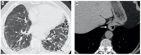 Welcome to read the #HighlyCited article on our #Pharmaceuticals Gastroesophageal Reflux Disease in Idiopathic Pulmonary Fibrosis: Viewer or Actor? To Treat or Not to Treat? by Ruaro et al. Enjoy reading: mdpi.com/1424-8247/15/8… @MDPIBiologySubj