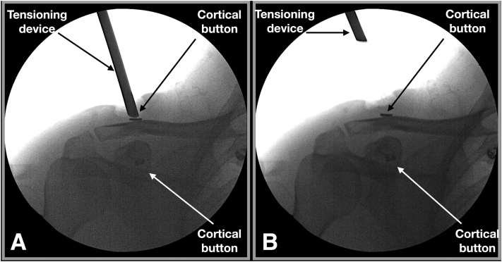 Here is the solution to the quiz: x.com/Rheumatology/s… The ultrasound images show the intact tibialis anterior allograft between the coracoid and clavicle and the cortical button of the clavicle Condition after Arthroscopic Acromioclavicular Joint Treatment With