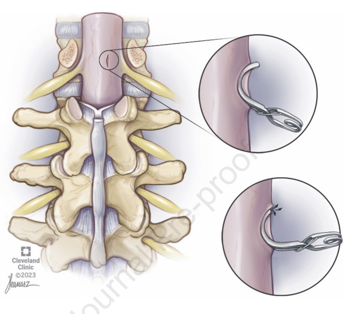 Great use for those aneurysm clips now that most aneurysms can be treated endovascularly. Clipping is back sciencedirect.com/science/articl…