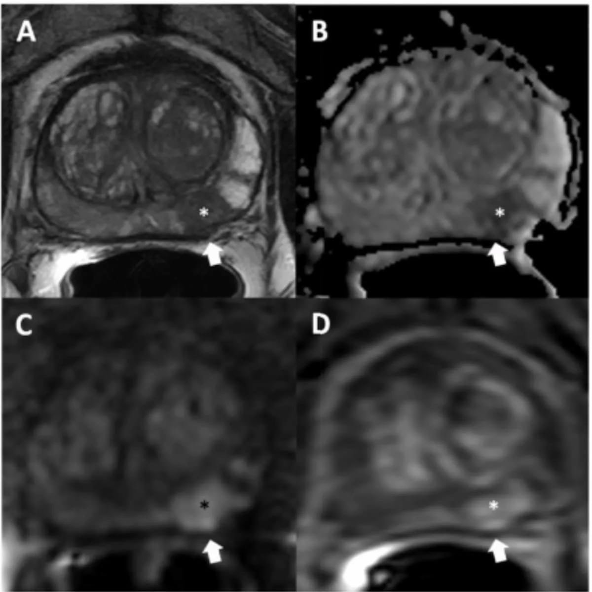 Predicting csPCa: Can a Prostate #MRI Point-Based Model Have an Impact? diagnosticimaging.com/view/predictin… @ACRRFS @ACRYPS @RadiologyACR @ARRS_Radiology @RSNA @SocietyAbdRad @StanfordRad @UofURadiology @UNMRadiology @UCSFimaging @UWRadiology @OHSURadiology #radiology #RadRes