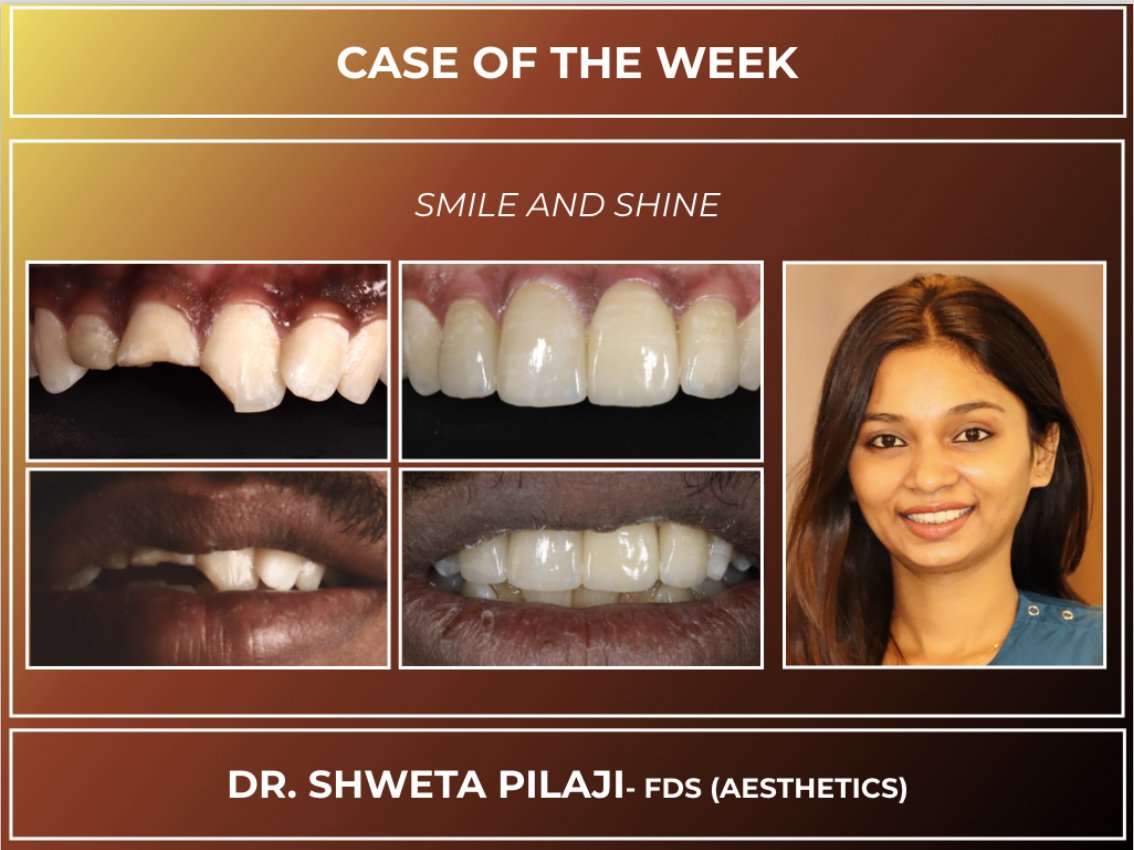 Case of the week - smile and shine #cosmeticdentist #dentist #cosmeticdentistry #dentistry #smile #veneers #smilemakeover #dental #teethwhitening #invisalign #teeth #dentalimplants #smiledesign #porcelainveneers #oralhealth #compositebonding #orthodontics #dentista #dentalcare