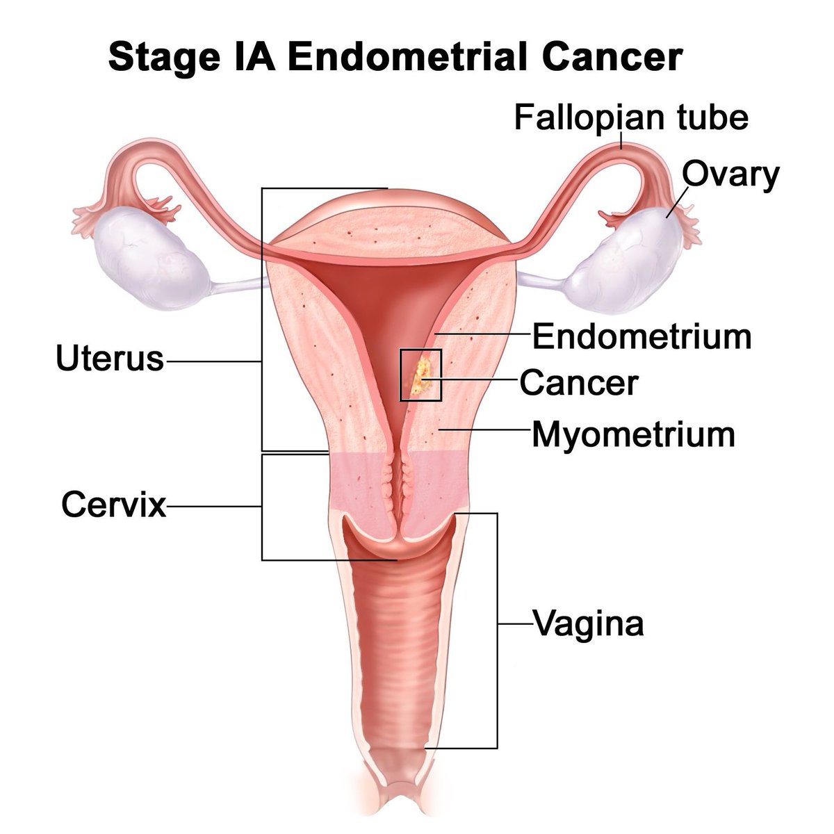 'Ursen, why did you get a hysterectomy?'

Well, I had Stage 1 Endometrial Cancer, it was caught early on. My Endometrium was too thick, I think it was 14 mm, and the internal lining was heterogeneous. Luckily, it was localized to a small area, so my surgery removed it entirely!