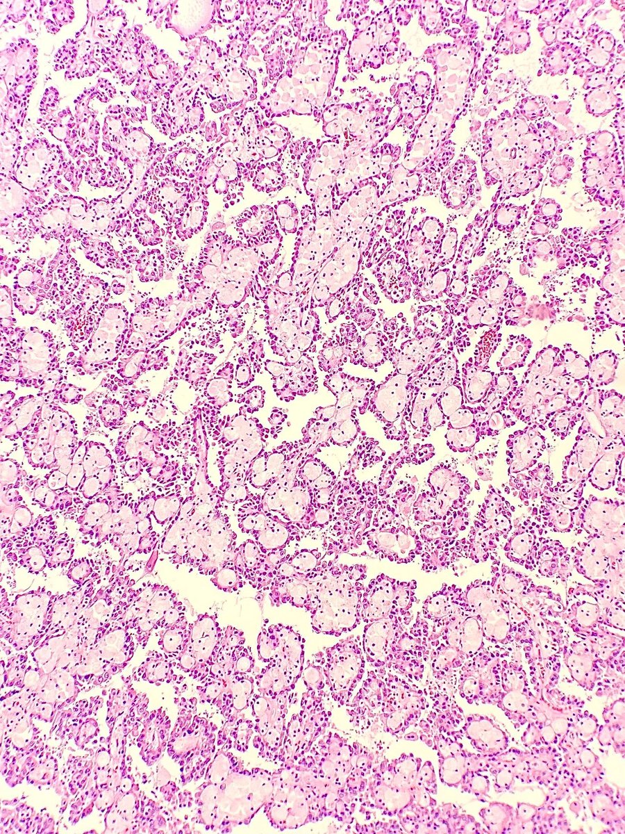 Nephrectomy specimen revealing small cuboidal cells are seen arranged in a single layer around papillary cores containing foamy macrophages. What tumor is this? Answer: buff.ly/3GyQZYt
#PathArt #PathTwitter #Cytopath #Pathology