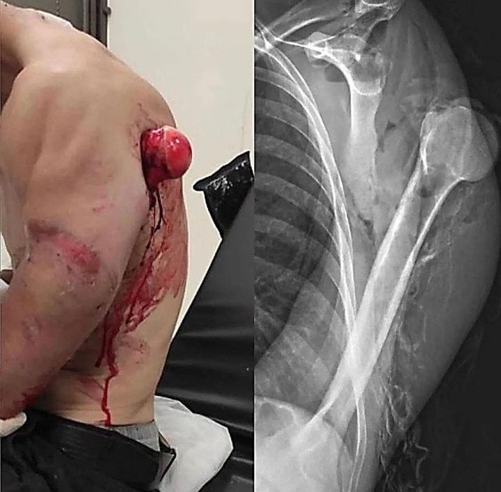 schowardjd's tweet photo. Complete dislocation of the humerus w/ posterior projection &amp; severe retroglenoid displacement, complex post-traumatic type, w/ open fracture &amp; external rotation of the humeral head &amp; complete tear of the glenohumeral joint capsule.

<📷/🩻 : SBRTO, https://t.co/Brlke7W6WM> https://t.co/dKgSqpwlkP