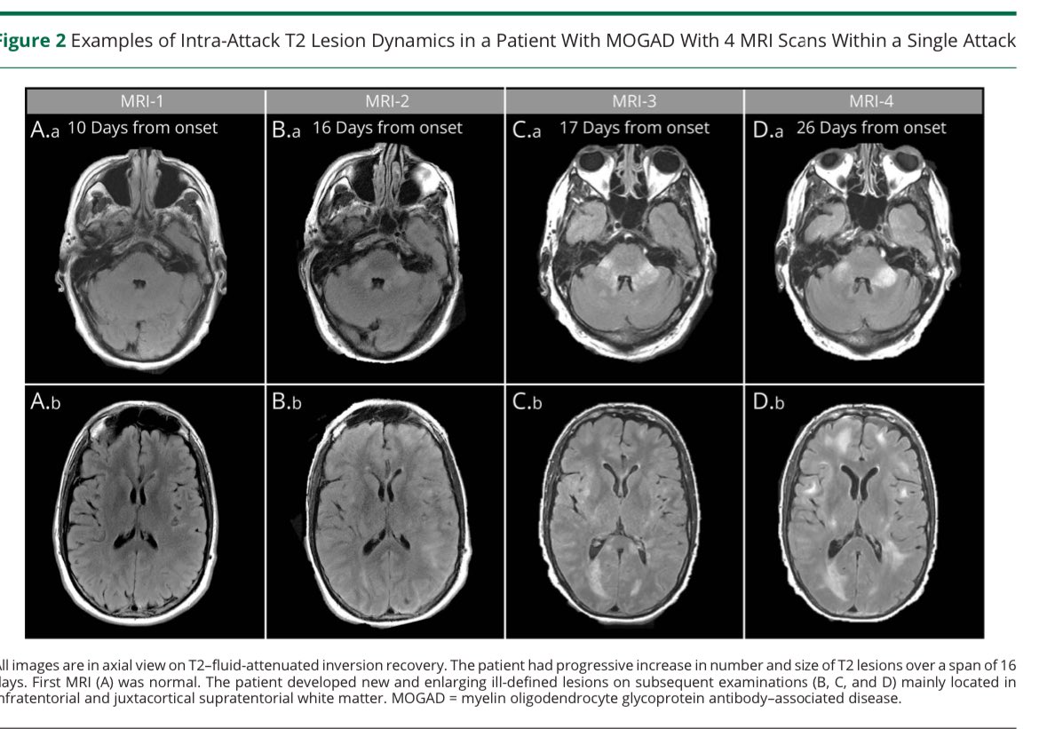 Radiologic lag is common within MOGAD attacks. Dynamic imaging with frequent appearance and occasional disappearance of lesions within a single attack suggest MOGAD diagnosis over MS and AQP4+NMOSD. . bit.ly/3WtFMCN