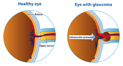 Cannabis for Glaucoma

A study entitled 'Cannabinoids for Treatment of Glaucoma' that was published in the journal Current Opinion in Ophthalmology investigated the potential efficacy of cannabis and its constituent cannabinoids and terpenes....

mrstinkysgreengarden.com/2024/04/cannab…