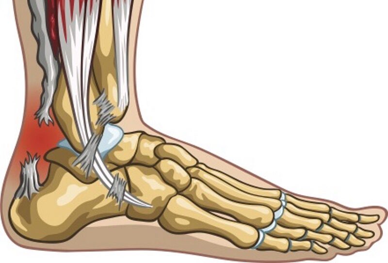 “ACHILLES RUPTURE” Now for our Twitter ballers who believe they can just stamp their feet on the floor and keep on playing, not when you have an “Achilles Rupture” like Presnel Kimpembe. The Achilles Tendon is a strong band that attaches the calf muscles (muscle behind your