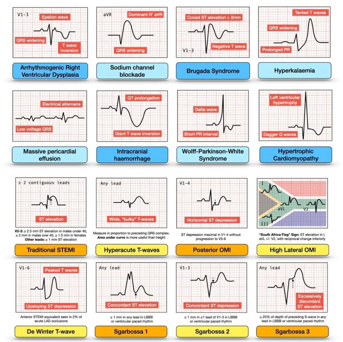 16 important ECG patterns that should not be missed. More ECG lecture: youtu.be/HFw6XszLASc