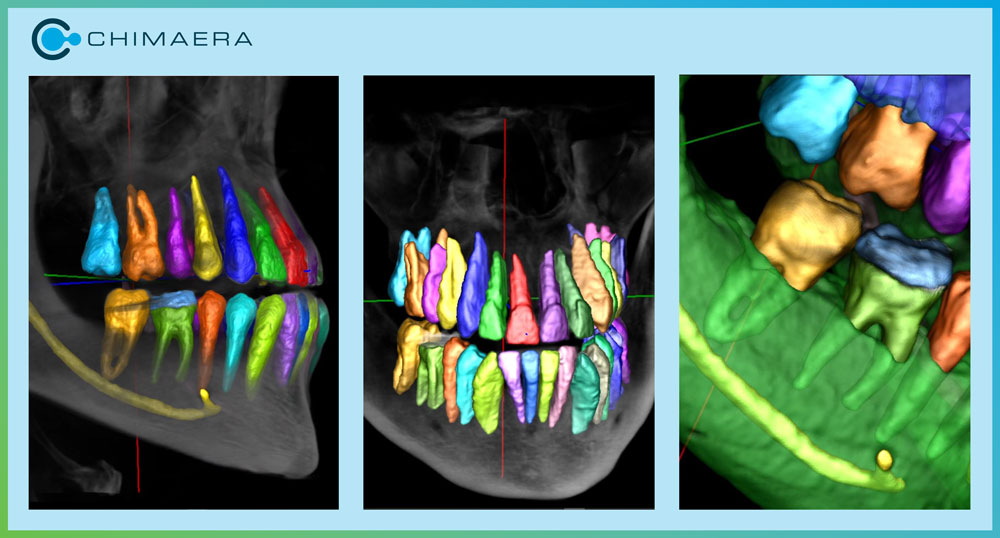 Revolutionize dentistry and streamline workflows with cutting-edge technology! @ChimaeraGmbH is proud to offer software expertise in the dental field: automated #recognition, fast #dataprocessing, multi-model integration, #genAI for customized implants or diagnostic support.