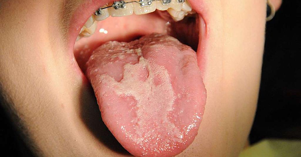 📙𝘾𝙇𝙄𝙉𝙄𝘾𝘼𝙇 𝙌𝙐𝙄𝙕:-

📝Geographic tongue is ideally b.'eated by:

A) Vitamin B-complex 
B) Iron 
C) Folic acid 
D) None of the above 

#medx
#medEd
#MedTwitter