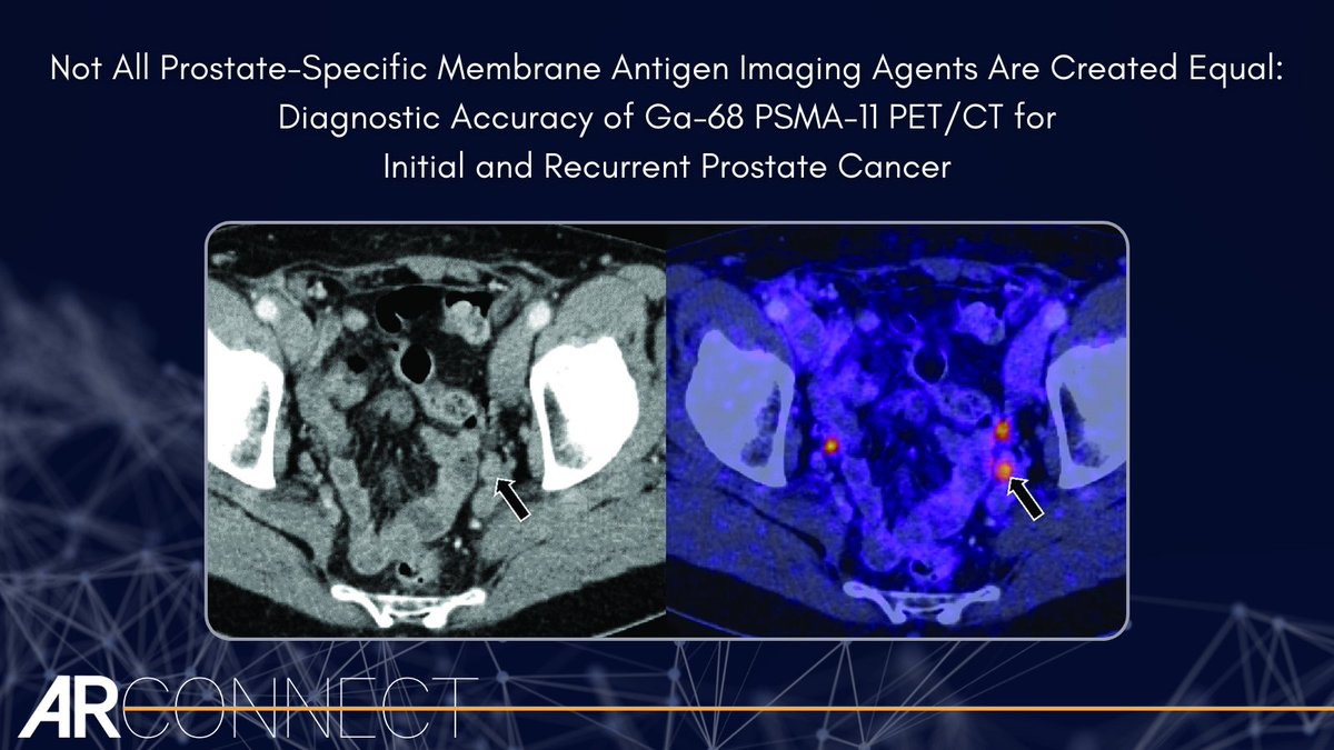 Ga-68 PSMA-11 PET has a favorable safety profile that affords high accuracy for PCa initial staging and the detection of PCa BCR. Learn more ➡️ bit.ly/4af4Ct3 #Radiology #MRI #Imaging #ProstateCancer #PET #PETCT #NuclearMed