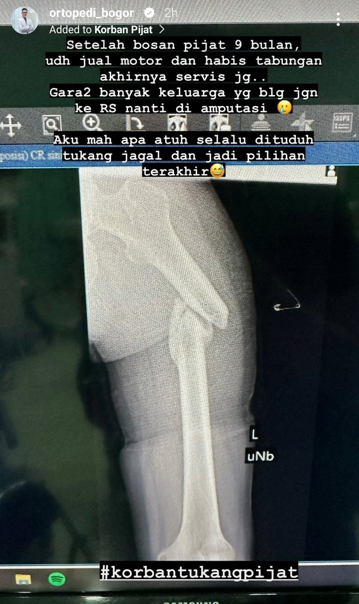 asaibrahim's tweet photo. Share dari seorang sahabat dokter orthopedi di kota bogor.

Prihatin dan sedih rasanya, utk berbagai salah paham dan stigma yg dipercaya masyarakat :
1. Ke rumah sakit mahal -> Pdhl bisa full ditanggung BPJS, malah ke alternatif mahal, jual mcm2 akhirnya ttp ga sembuh

2. Ke dokter nanti diamputasi -> Kami dokter, bukan tukang jagal daging, tindakan amputasi adalah pilihan tindakan TERAKHIR, saat kakinya sudah mati/terinfeksi berat/rusak yang sangat berat, yang ironisnya banyak terjadi akibat pengobatan alternatif.

Yukk teman2, lebih kritis lagi ya dengan pengobatan utk kita dan saudara kita