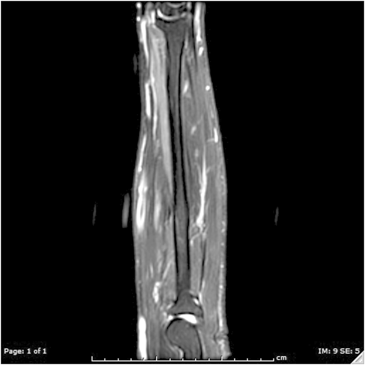 Isolated Palsy of the Anterior Interosseous Nerve to Flexor Pollicis Longus, Magnetic Resonance Imaging and Clinical Correlation #handwrist bit.ly/4addEqA