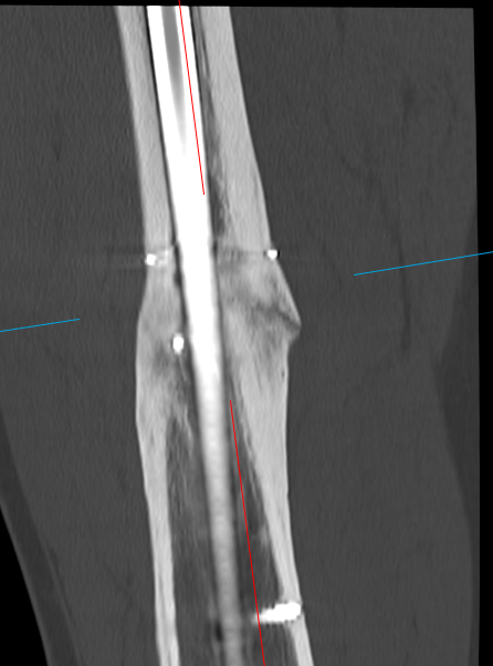 All hail the 3.5mm strain-relief-screw

3 month follow up

#orthotwitter @deepamusafir1 @InvictaOrtho