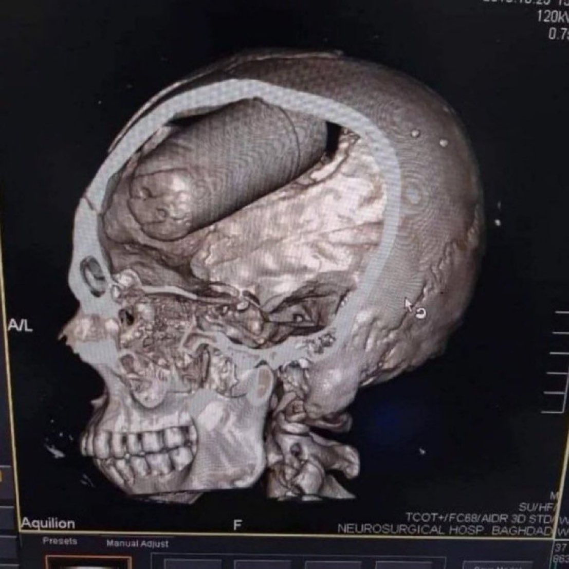 ‘Harrowing X-ray reveals a tear gas canister that tragically became embedded in a protester's brain during anti-government protests in Iraq in 2019.’ Via @Morbidful