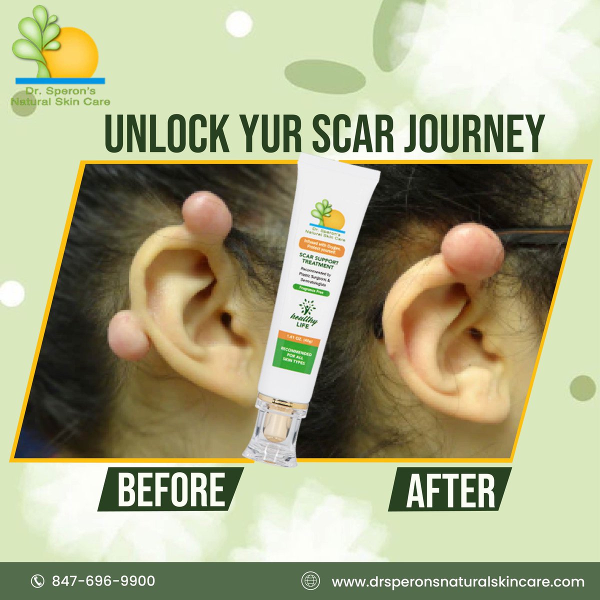 prplastic's tweet photo. Unlock Your Scar Journey
https://t.co/wIIuMcGIO2
#spotlessface #facialskincare #FlawlessSkin #SkinRadiance #scars #scartreatment #scartherapy #FacialTreatment #scarremoval #acnescars #scarcream #ScarTreatment #skincare #blemishfree #AcneScarTreatment #SkinExperts #SkinHealth https://t.co/xBNnQ8MjqV