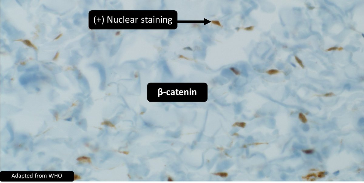 Germline ___ mutations are seen in familial cases of ___
a) APC
b) CTNNB1
#PediPath #BSTPath #PathTwitter #GIPath #pathology