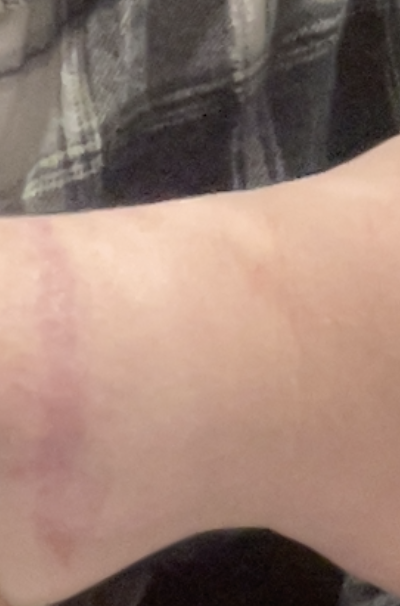 yakaiyon's tweet photo. @luvlyb0wz oh hell nah staples are so scary 😭 but thats crazy because i have a scar in that exact spot i got stitched 😭 photo is a scar and looks weird bc i had to crop my bracelets out https://t.co/MDB2OiMVNh