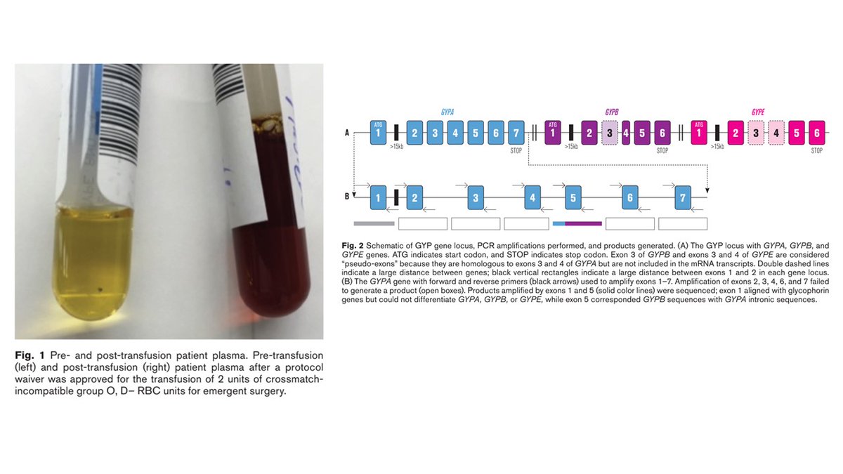 An extraordinary case of rare En(a-) RBC phenotype due to lack of glycophorin A. Strong anti-Ena antibodies, HTR after 24 hours after transfusion. No En(a-) donors in USA, compatible blood found in Qatar. tinyurl.com/4h8jv9cr #blood_groups #glycophorins