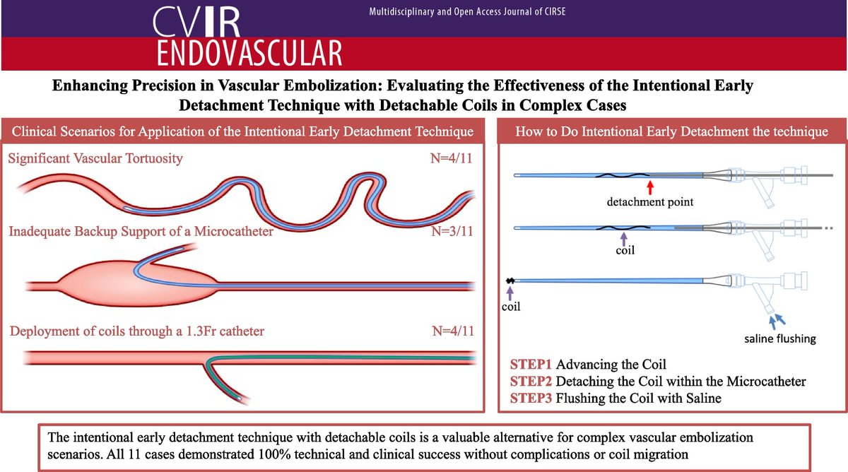 This novel approach aims to provide an alternative method for achieving precise coil placement when standard methods of detachable coil placement are ineffective owing to vascular anatomy or limited available equipment: cvirendovasc.springeropen.com/articles/10.11… #IRad