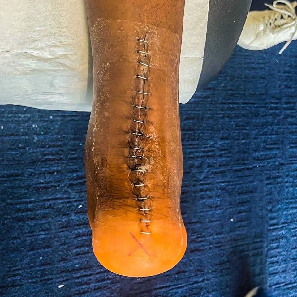 Presnel Kimpembe shows the reality of his most recent injury. He suffered an achilles tendon rupture which has kept him out of action for more than 400 days. These player deserve the money they get paid for except Rashford and Antony