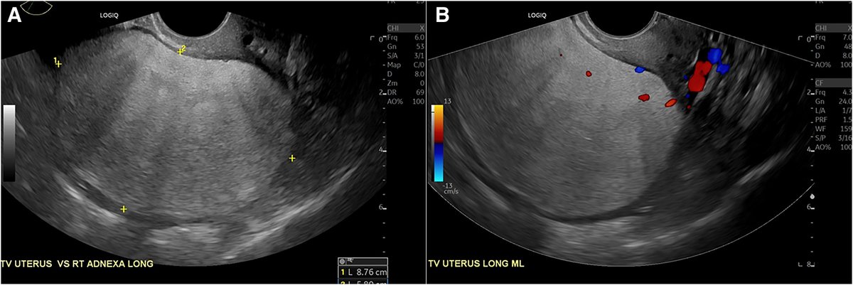 AJOG Images in Gynecology:  Fatty intrusion in the uterus: a rare case of uterine lipoleiomyoma causing urinary retention - Pelvic ultrasound. ow.ly/eqZq50RFozs