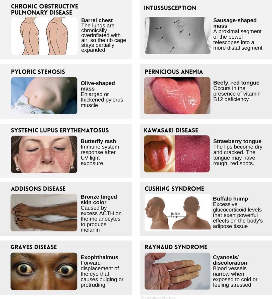 Hallmark signs and symptoms 🤓 📚 

#MedEd #FOAMed #FOAMcc #medtwitter #emergency #medicine #medicaleducation #MedicalStudents 
#LiverTwitter #MedStudentTwitter 
#medicalpractice #icu #CriticalCare